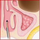 step-3-balloon-sinus-dilation